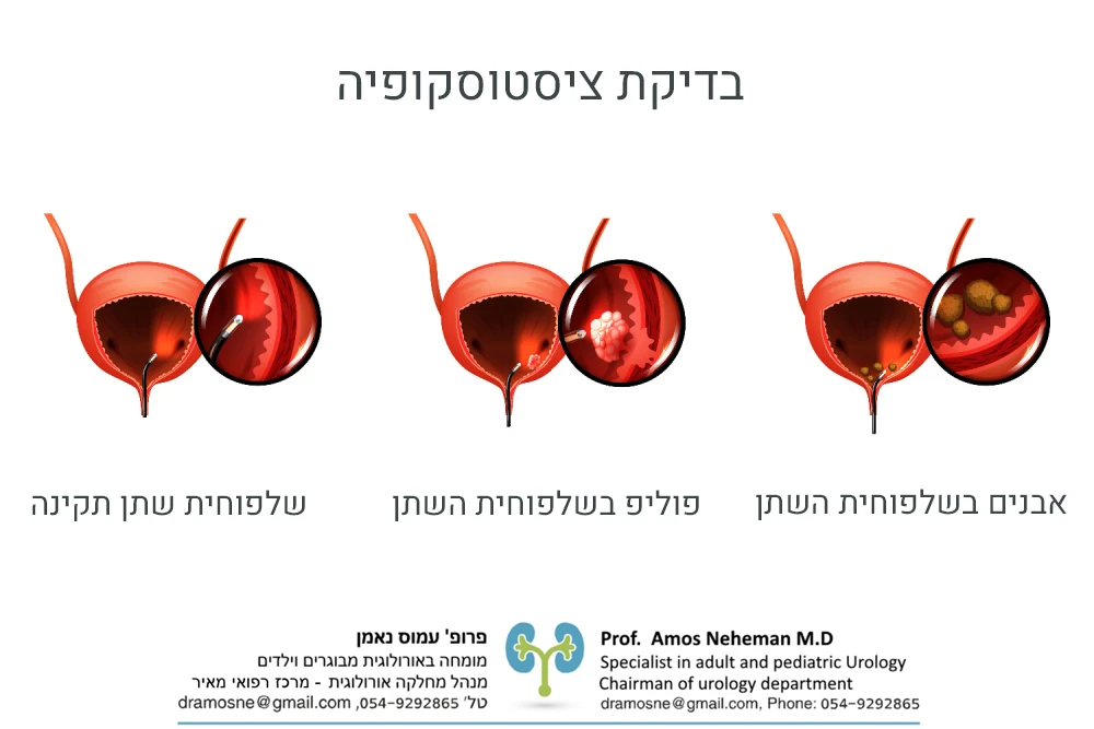 בדיקת ציסטוסקופיה