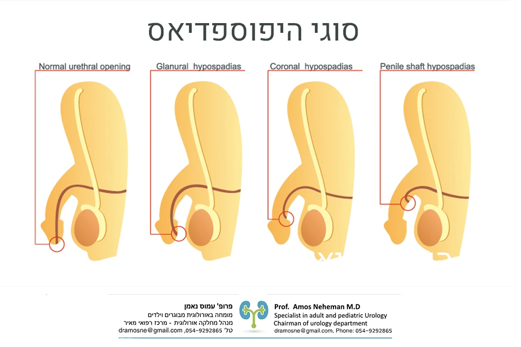 סוגי היפוספדיאס