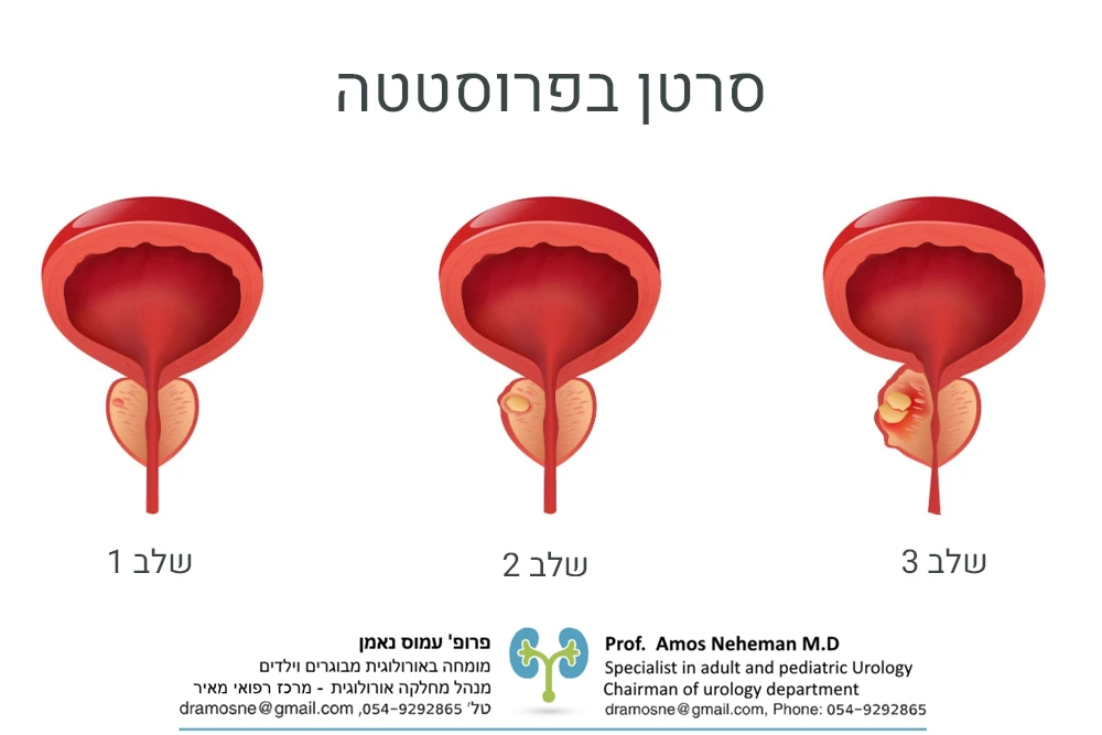 סרטן בפרוסטטה שלבים