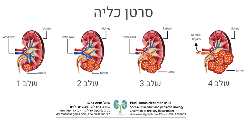 סרטן כליה 4 שלבים