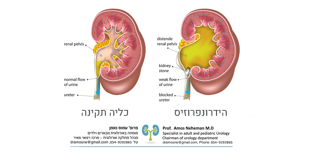 הידרונפרוזיס התרחבות כליה